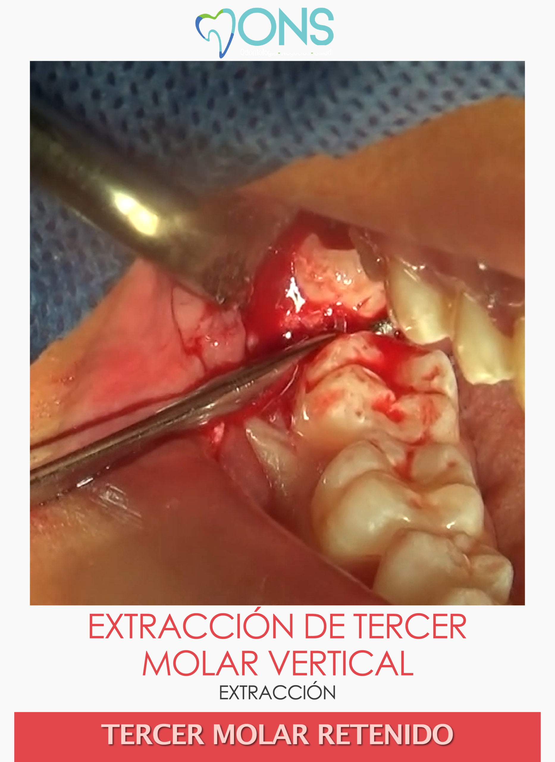 M Extracci N De Tercer Molar Vertical Odontoflix Net