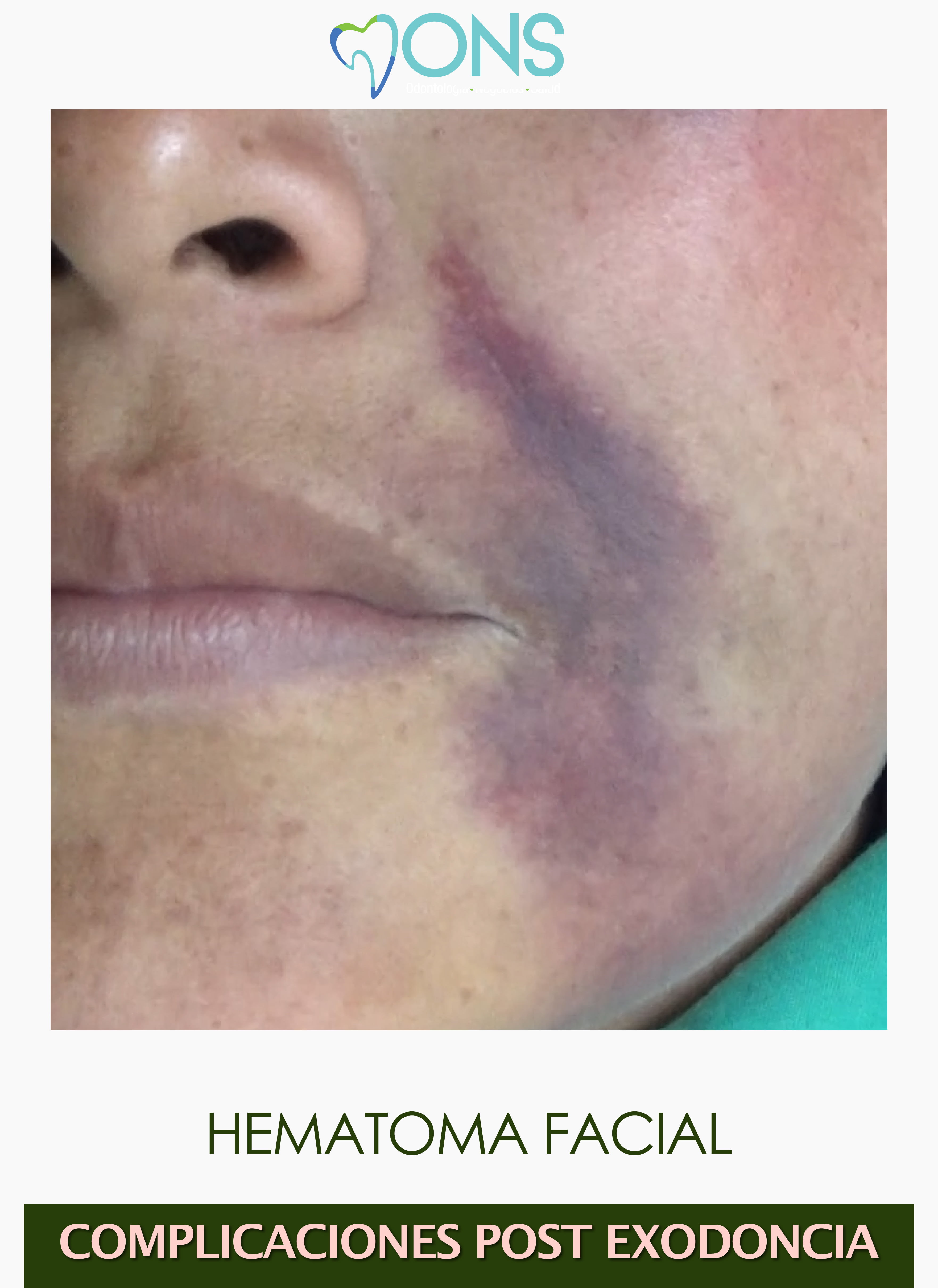 f006-hematoma-facial-odontoflix